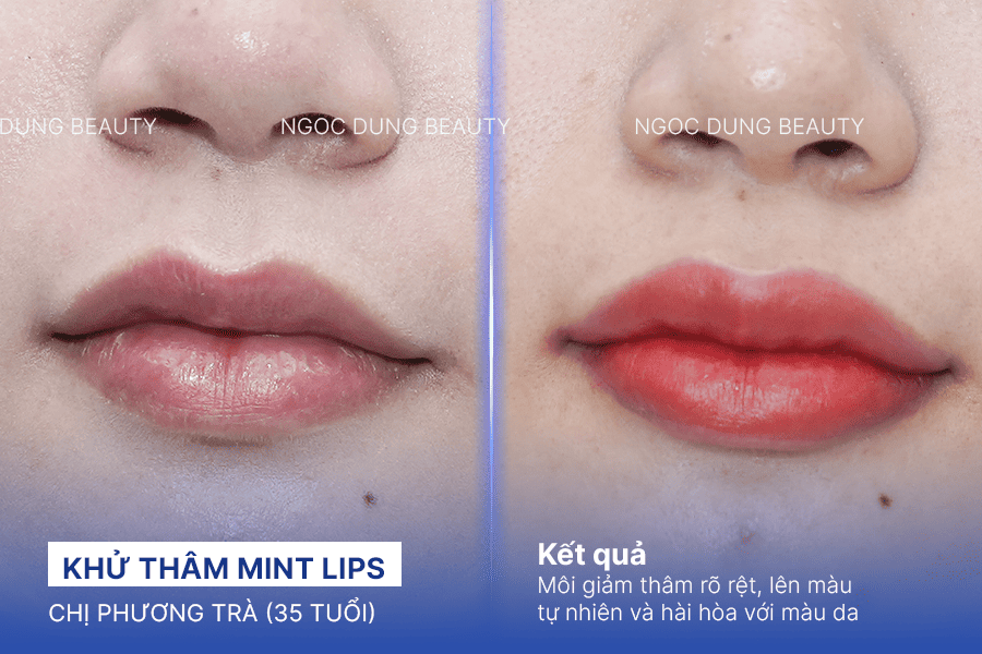 Before/ After Phun khử thâm môi