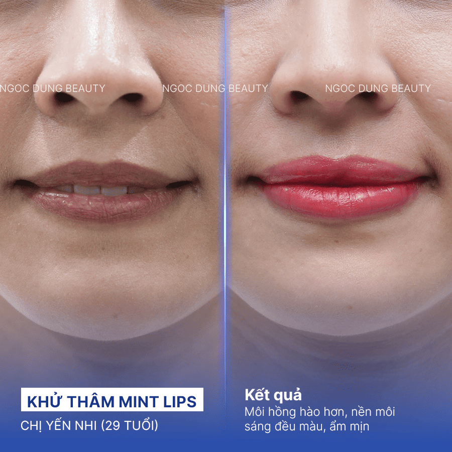 Before/ After Phun khử thâm môi