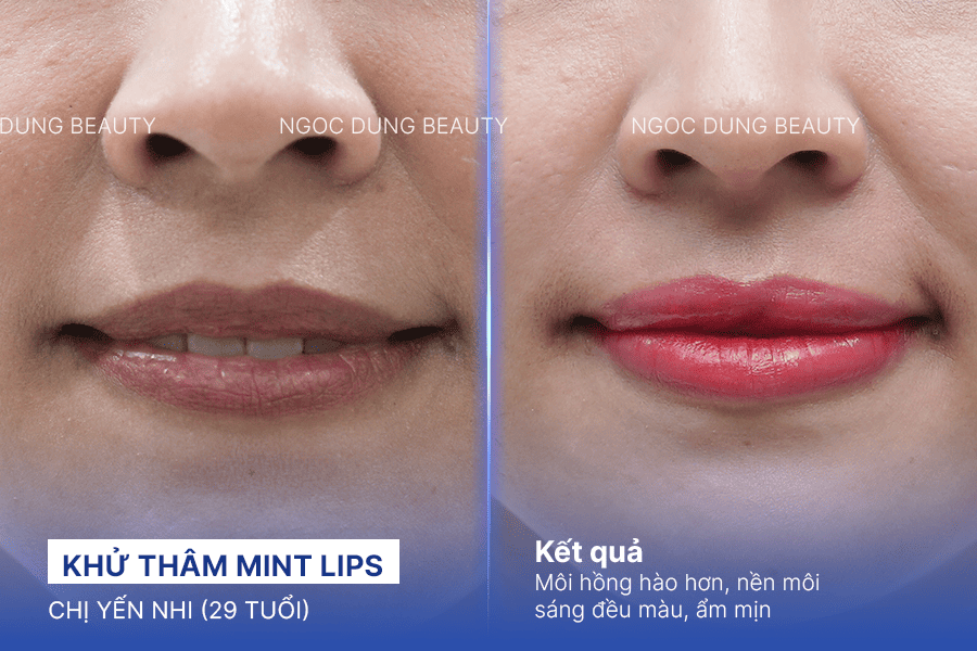 Before/ After Phun khử thâm môi