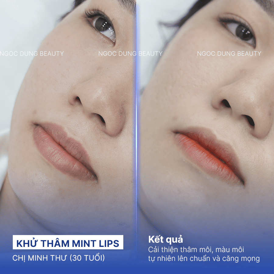 Before/ After Phun khử thâm môi