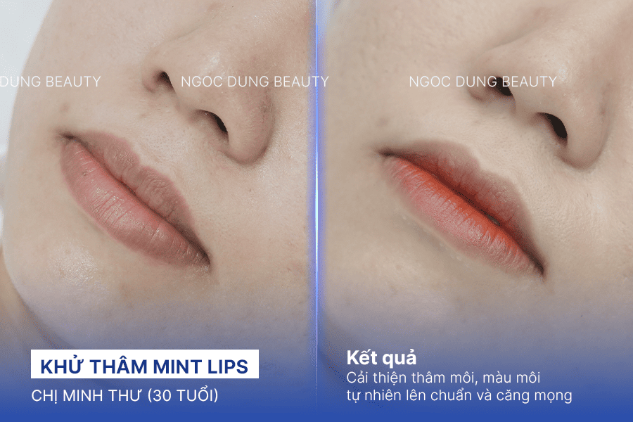 Before/ After Phun khử thâm môi