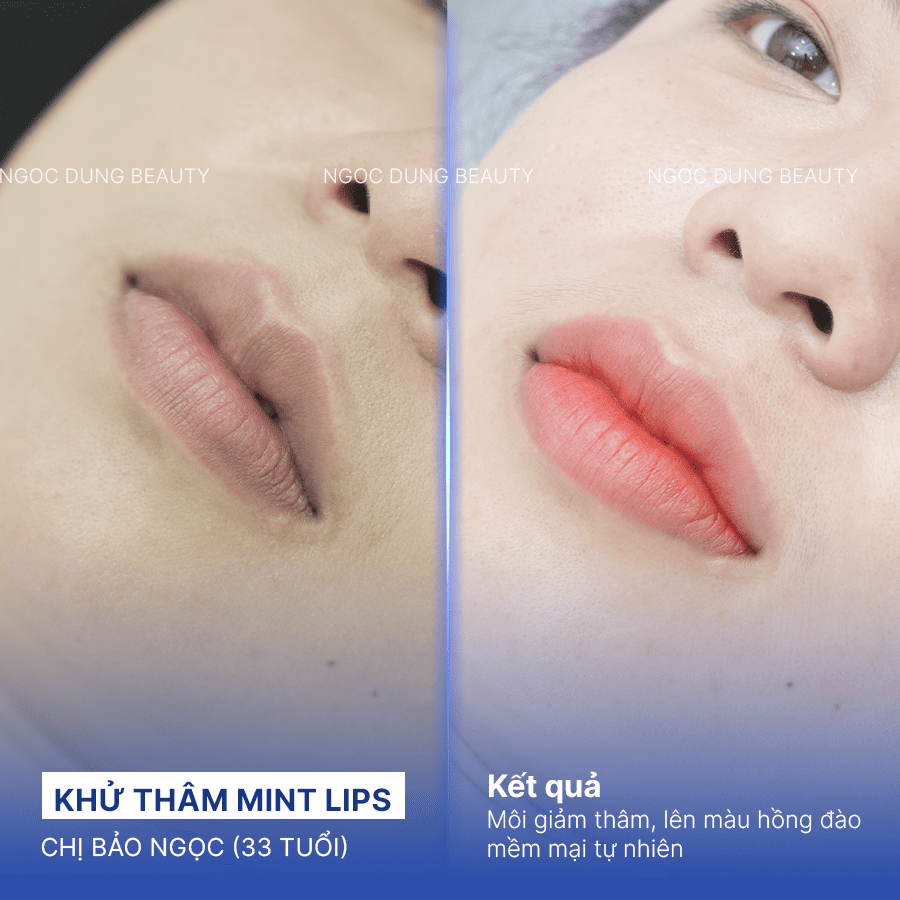 Before/ After Phun khử thâm môi