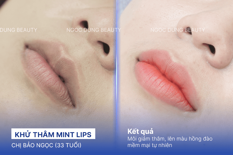 Before/ After Phun khử thâm môi