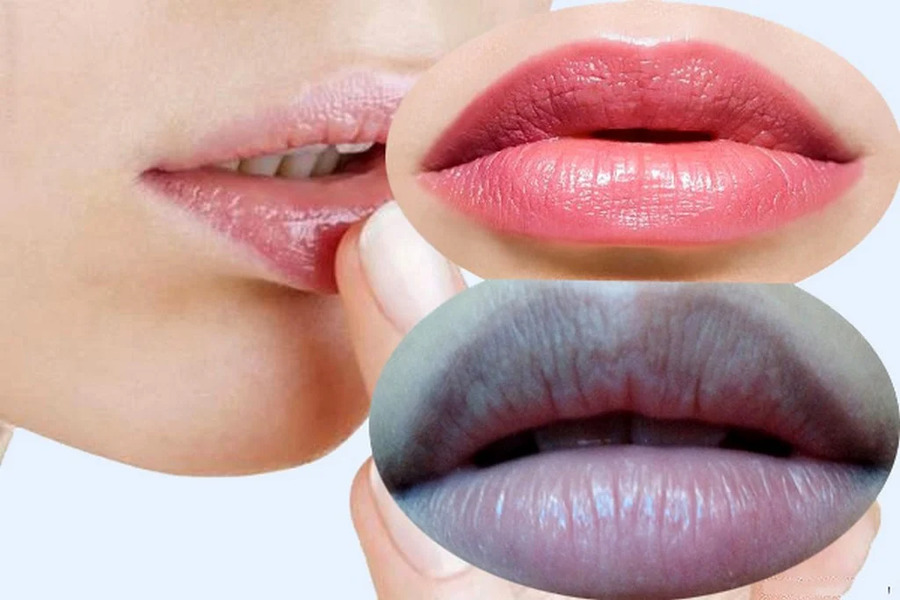 Khử thâm môi đặc biệt phù hợp với những ai đang gặp vấn đề liên quan đến sắc tố môi